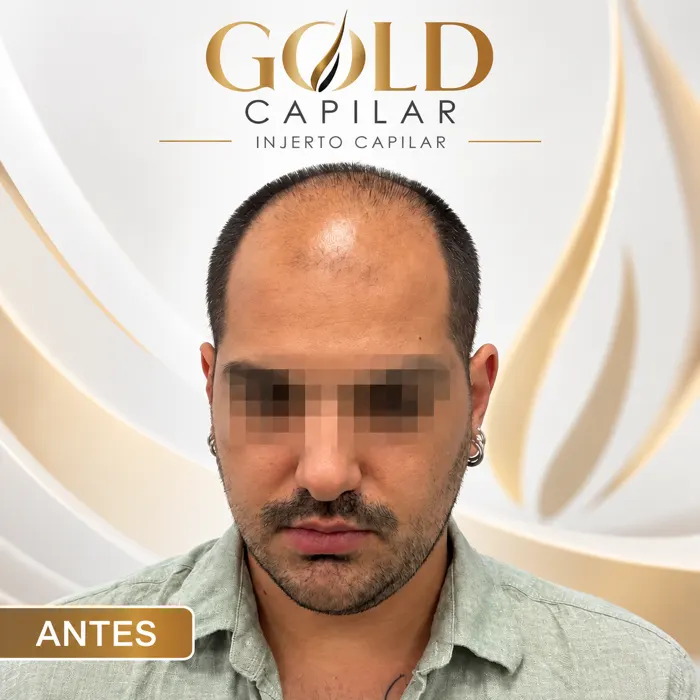 Paciente José antes del injerto capilar