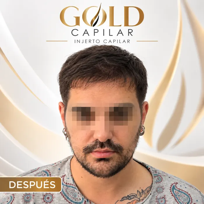 Paciente José después del injerto capilar