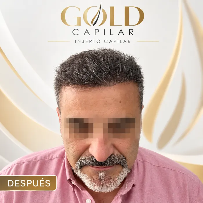 Paciente Juan después del injerto capilar